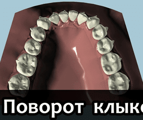 Что такое Элайнеры?