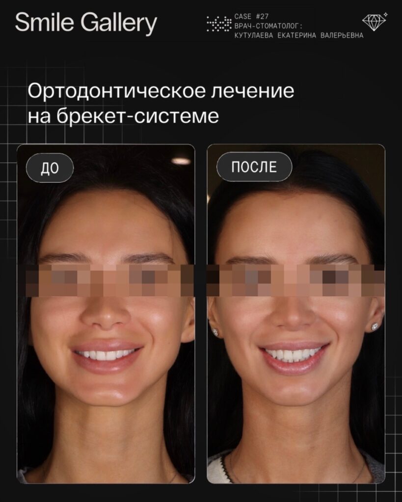 Ортодонтическое лечение и овал лица